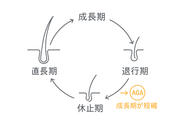 AGAで乱れるヘアサイクルの3段階|成長期短縮の図解