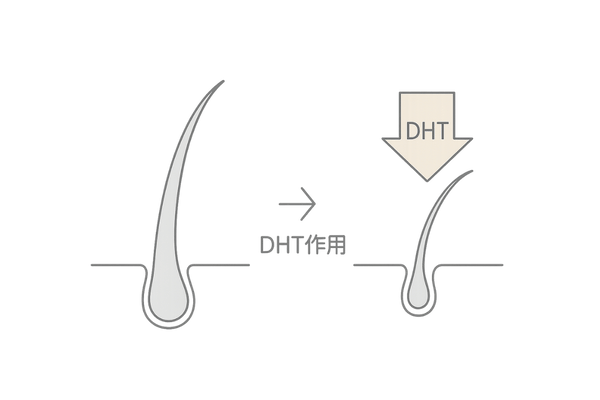 AGAとDHTの関係を示す毛根図解