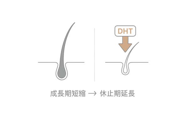 DHTが毛母細胞に与える影響とAGA進行イラスト