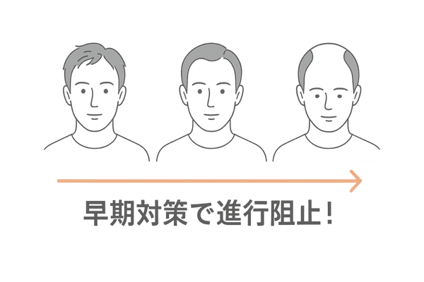 M字はげ進行ステージと早期対策イラスト