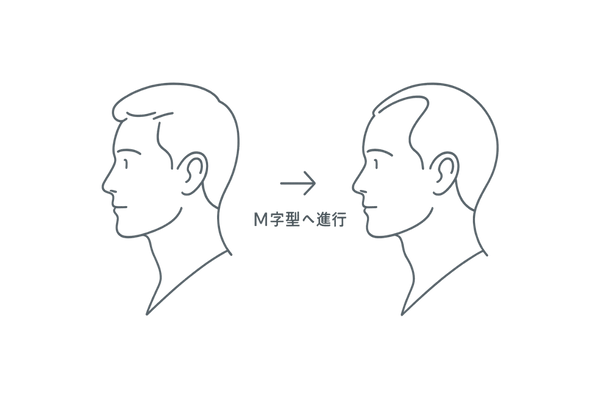 M字はげの生え際進行イラスト―正常との比較