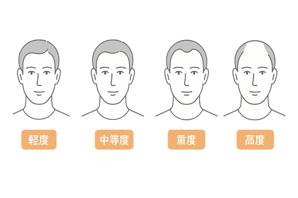 M字はげ進行ステージ比較イラスト