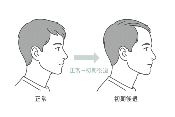 若年性生え際後退のビフォーアフター比較イラスト