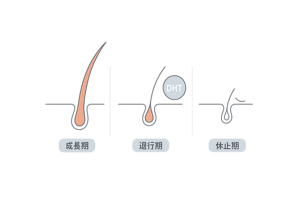毛髪の成長周期と男性ホルモンの影響を図解したイラスト