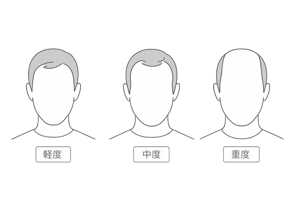 M字ハゲ進行度別イラスト