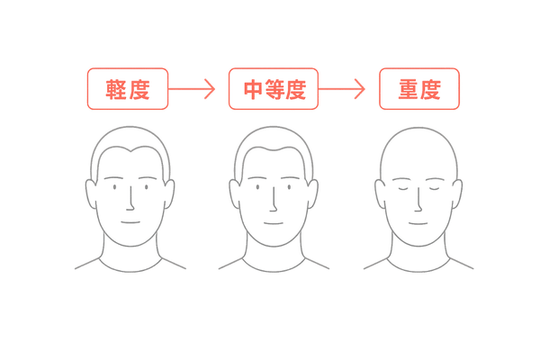 M字型生え際進行ステージ図|軽度・中等度・重度