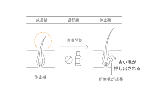 AGA初期脱毛の仕組み|毛周期と“古い毛の押し出し”を図解