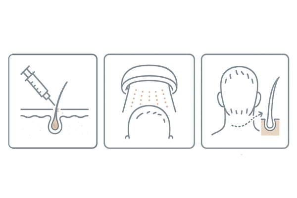 薬以外のAGA治療オプションを比較(メソセラピー・育毛レーザー/LED・自毛植毛)