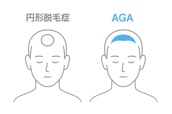 円形脱毛症とAGA