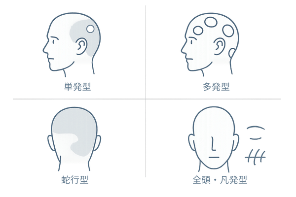 10円ハゲ(円形脱毛症)のタイプ比較図:単発型・多発型・蛇行型・全頭/汎発型の違い
