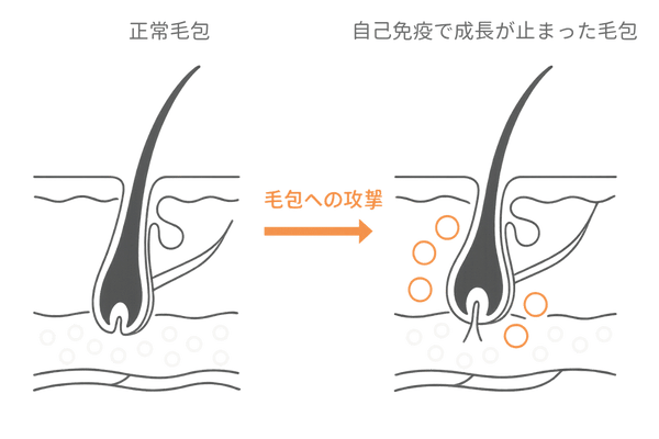 円形脱毛症が眉毛に起こる仕組み|毛包と免疫反応の解説イラスト