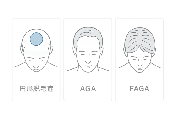 円形脱毛症とAGA・FAGAの違いを一目で比較(原因と見た目のパターンの図解)