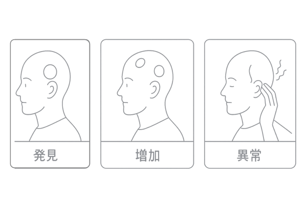 円形脱毛症で受診すべきタイミング(症状の目安を3例で視覚化)