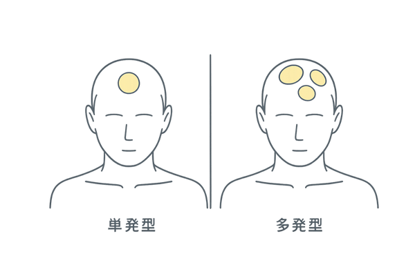 単発型と多発型の円形脱毛症の違い|頭部アイコン比較図(男性向け)