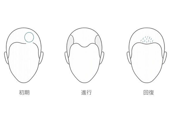 前頭部円形脱毛症の初期~進行ステップ図