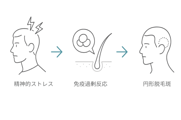 ストレスと免疫反応が引き起こす円形脱毛症フロー図