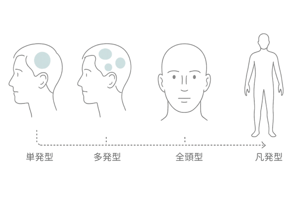 円形脱毛症4タイプの違いを示す比較アイコン