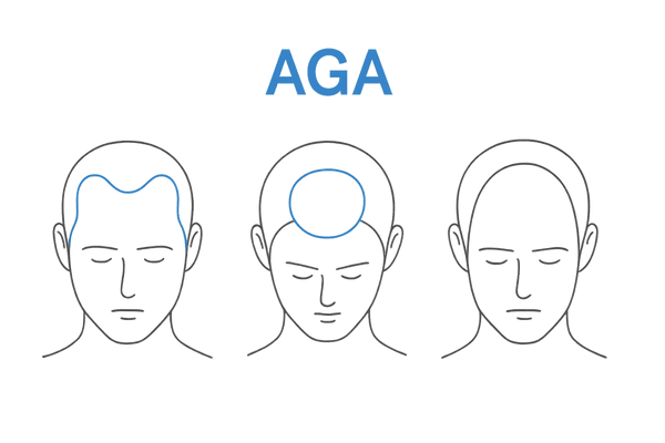 AGAの進行パターン(M字・O字・U字)