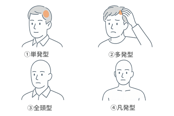 円形脱毛症の4タイプ比較｜単発・多発・全頭・汎発 イラスト