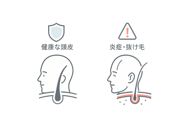 健康頭皮と炎症頭皮の比較図
