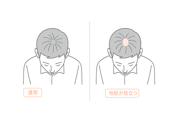 つむじの渦構造と地肌の見え方比較|つむじはげ判断用イラスト