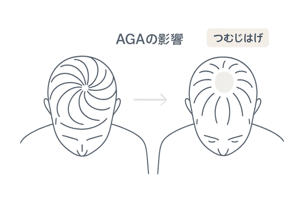 つむじはげとAGAの関連を示すイラスト