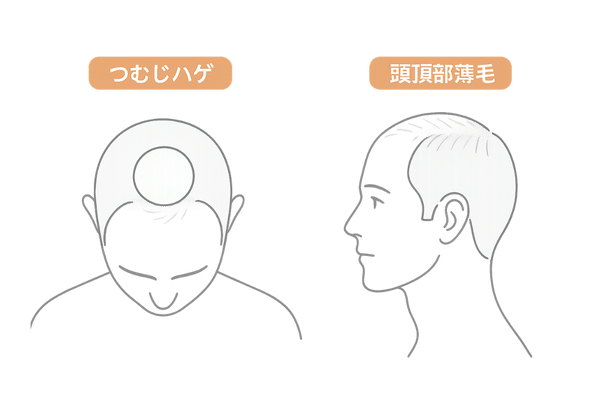 つむじハゲと頭頂部薄毛の違いイラスト｜比較図