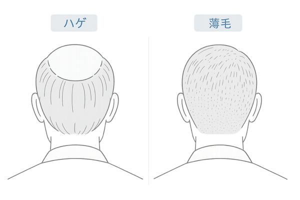後頭部のハゲと薄毛の違い|つむじ周りの見え方を比較(男性向けAGA解説)