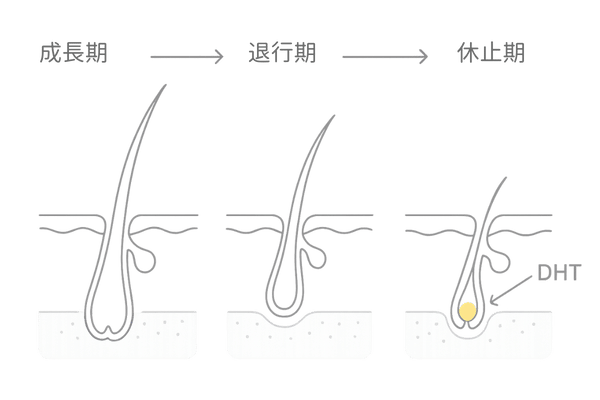 薄毛の進行メカニズム|ヘアサイクル短縮とDHTの影響(毛包断面とタイムライン)