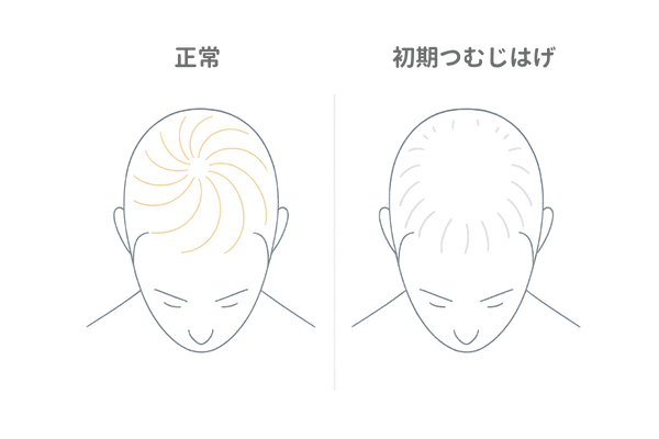 正常頭頂部と初期つむじはげの比較イラスト