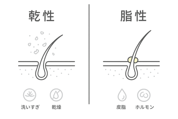 乾性フケと脂性フケの違い|症状・頭皮状態・原因を左右比較した線画イラスト(男性の頭皮ケア)