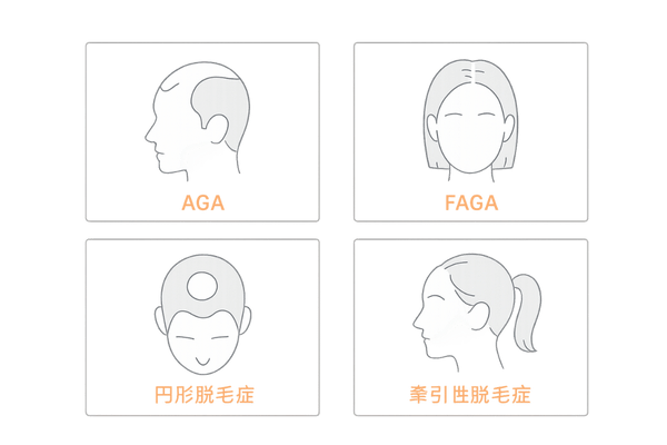 脱毛症タイプ別に見る薄毛パターン比較図