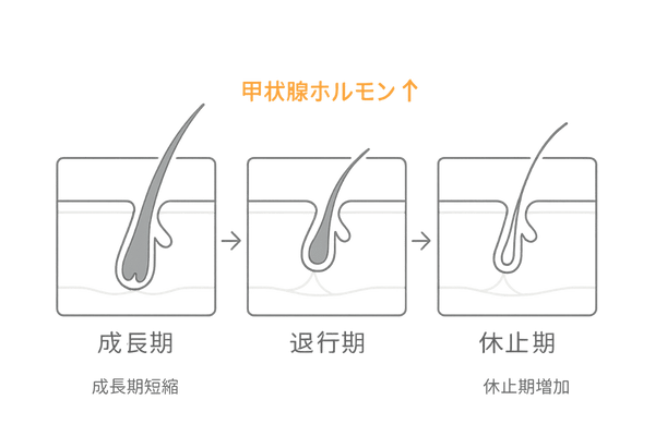甲状腺ホルモン過剰と毛周期の乱れ（成長期短縮のイメージ）