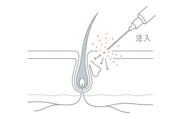 幹細胞注入療法の仕組み|頭皮への成長因子注入と毛包活性のイメージ