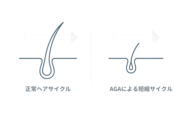 正常ヘアサイクルとAGA短縮サイクル比較図