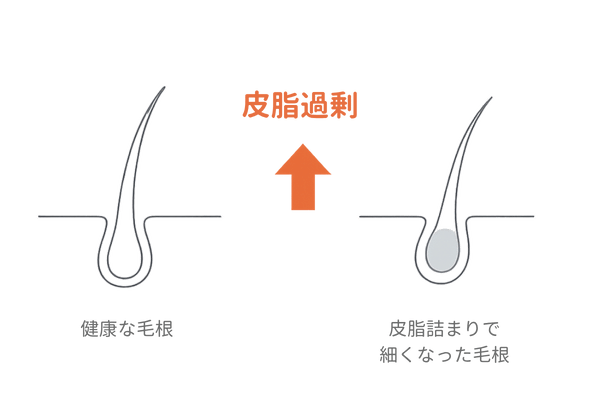 高校生の抜け毛の原因である皮脂詰まりのメカニズムイラスト