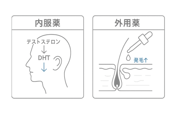 内服薬と外用薬の役割比較|男性AGA発毛治療の使い分け図解