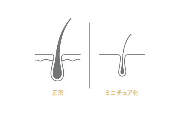 20代薄毛初期サイン比較イラスト