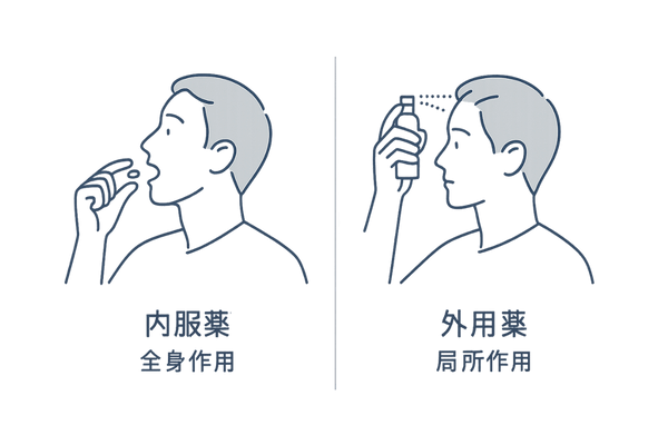 AGA投薬治療内服外用比較イラスト