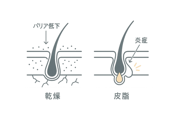 季節の変わり目で乱れる頭皮バリア|乾燥と皮脂過剰の比較図
