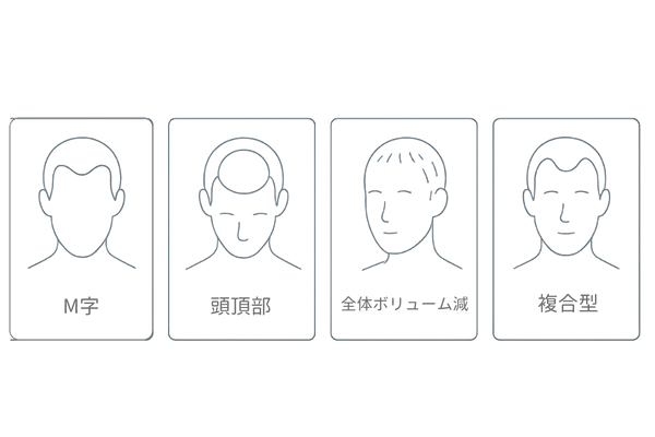 男性の抜け毛パターン4種を比較するイラスト