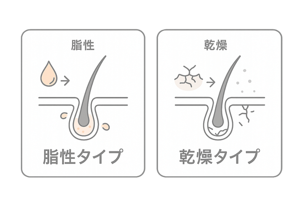 頭皮タイプ別セルフチェック図解｜育毛シャンプー選びの基礎