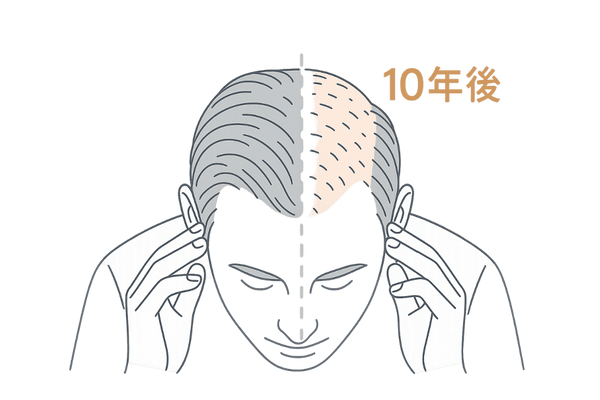 自毛植毛10年後のパッチワークリスクイメージ