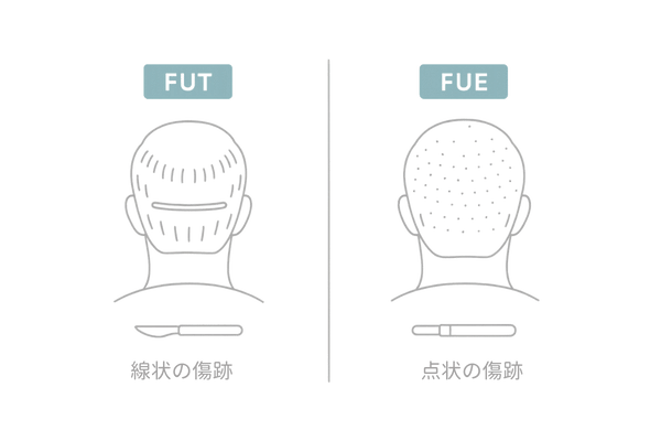 FUT法とFUE法の違いを比較｜採取方法と傷跡（線状痕・点状痕）の図解