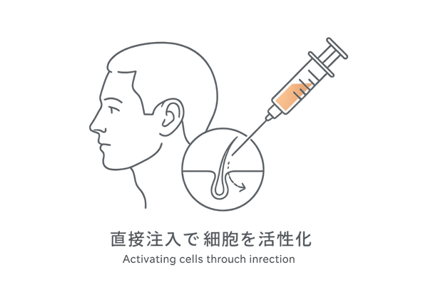HARG療法の成長因子注入イメージ