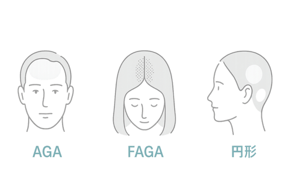 AGA・FAGA・円形脱毛症の違い|遺伝性薄毛の見分け方を図解
