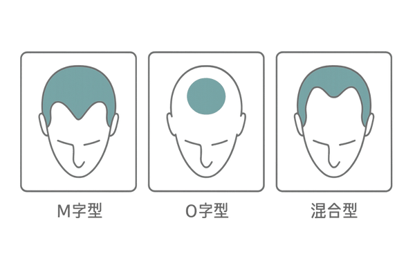 AGA進行パターンM字・O字・混合型イラスト