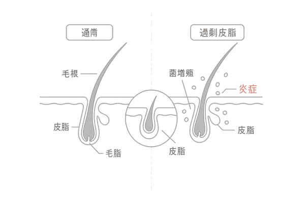 マラセチア毛包炎|毛穴断面で見る炎症メカニズム(頭皮の皮脂・菌増殖・炎症の関係)