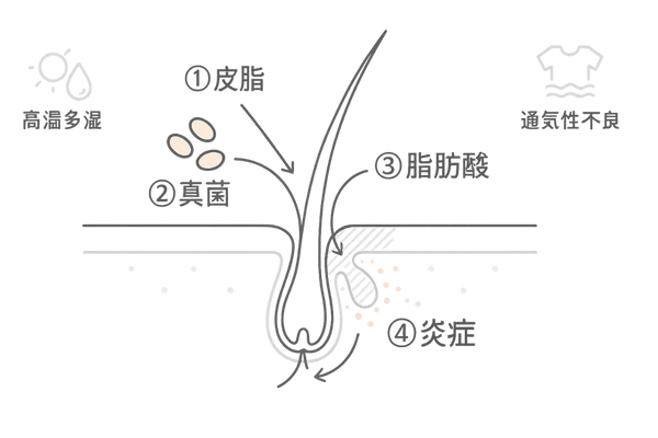 マラセチア毛包炎が起こるメカニズムの頭皮断面図(皮脂・真菌・炎症の流れ)