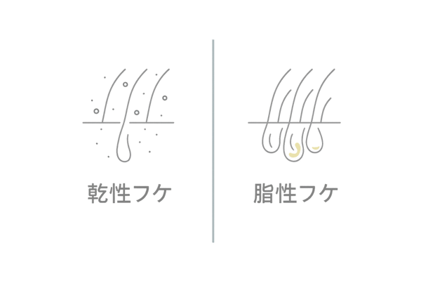 乾性フケと脂性フケの違い比較図